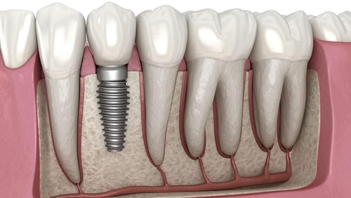 Çorlu İmplant Tedavisi Nedir? Kimlere Yapılır?  Dt. Uğur Melih Yıldız – AQUA Dental Çorlu / Diş Hekimi